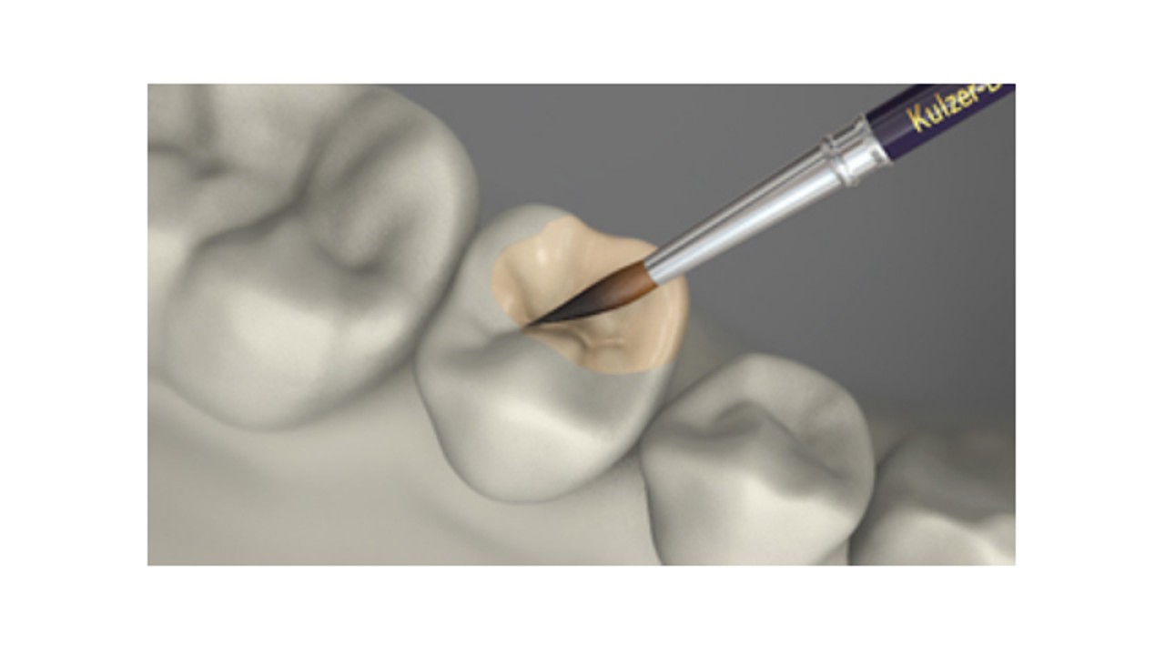 Υλικά επικάλυψης σκελετών χωρίς μέταλλο