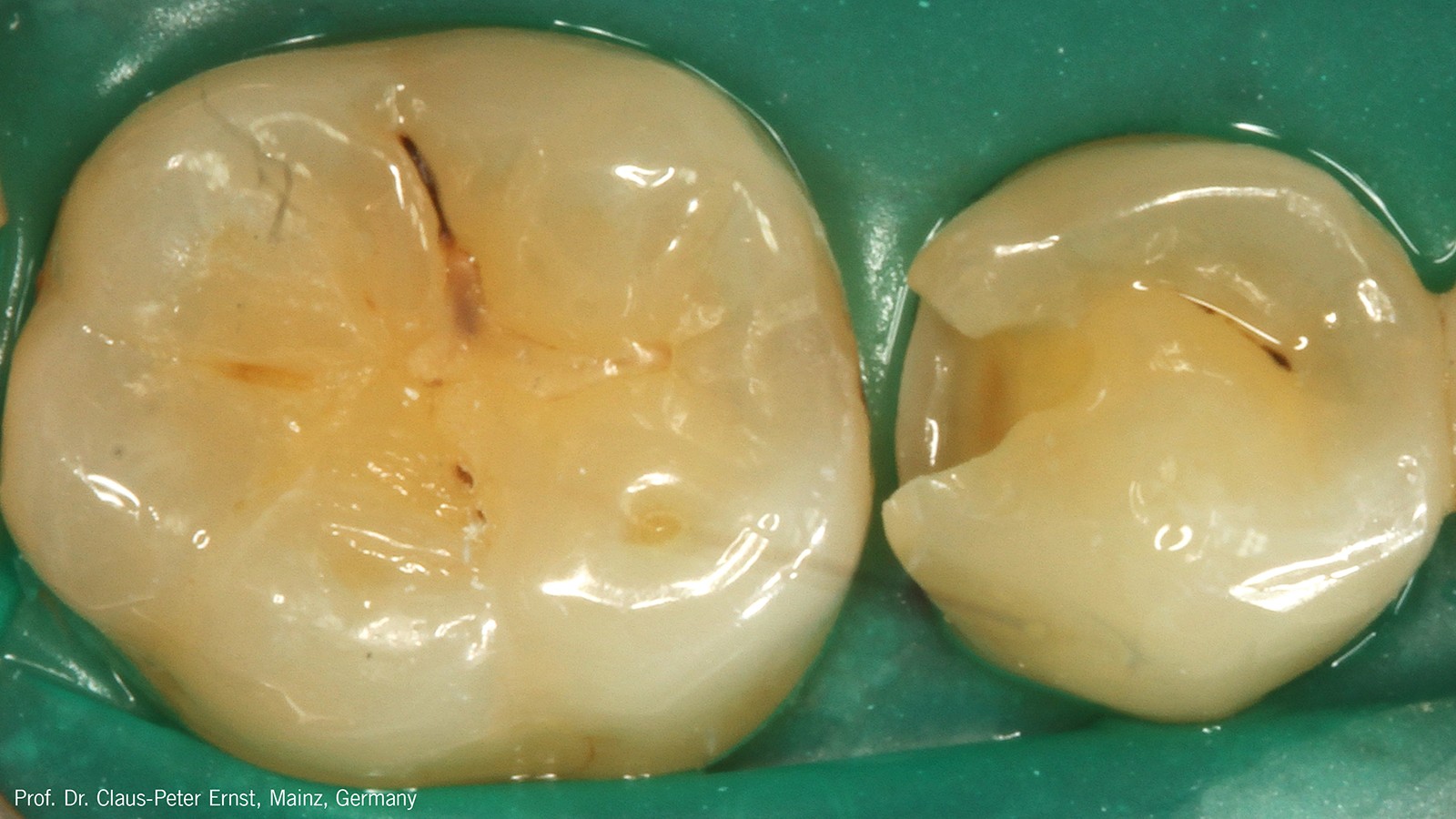 Τροχισμός και προετοιμασία της κοιλότητας με την χρήση απομονωτήρα. 