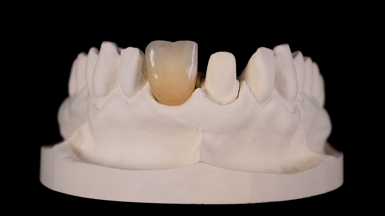 Ρωγμές αδαμαντίνης και λευκή κηλίδα (lime spot)