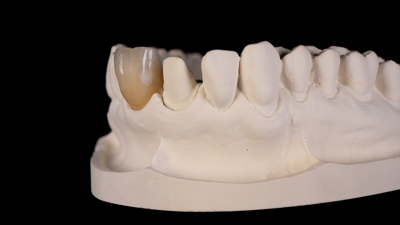 Τελικό αποτέλεσμα της λευκής κηλίδας αδμαντίνης