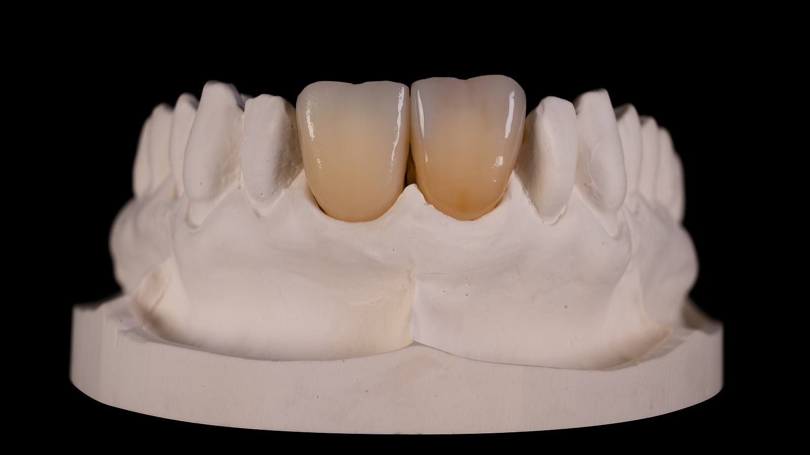 Apply HeraCeram cre-active 2D Anthracite distally and blend out towards the incisal edge.