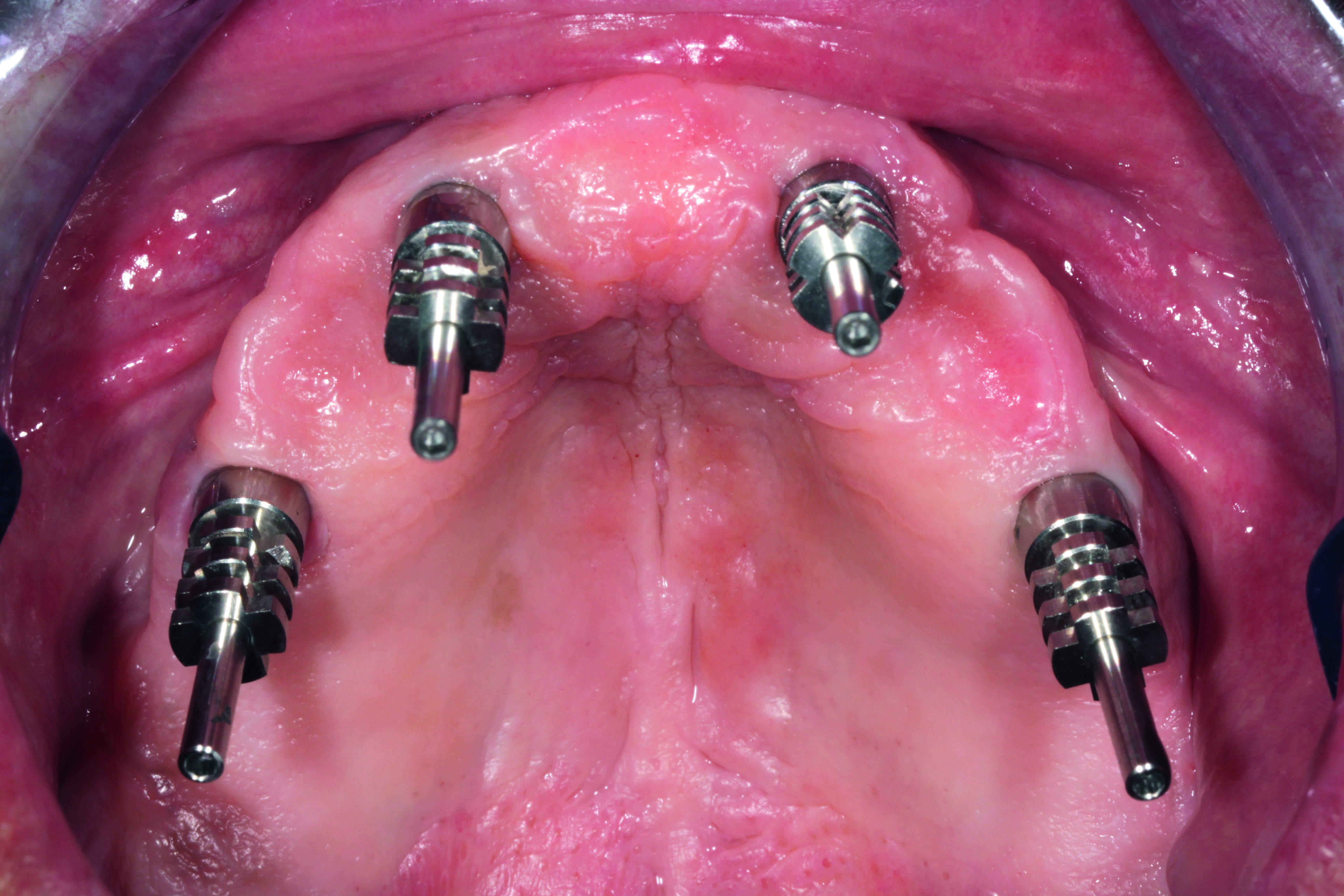 Ακριβής τοποθέτηση των αναλόγων εμφυτευμάτων στο αποτύπωμα.