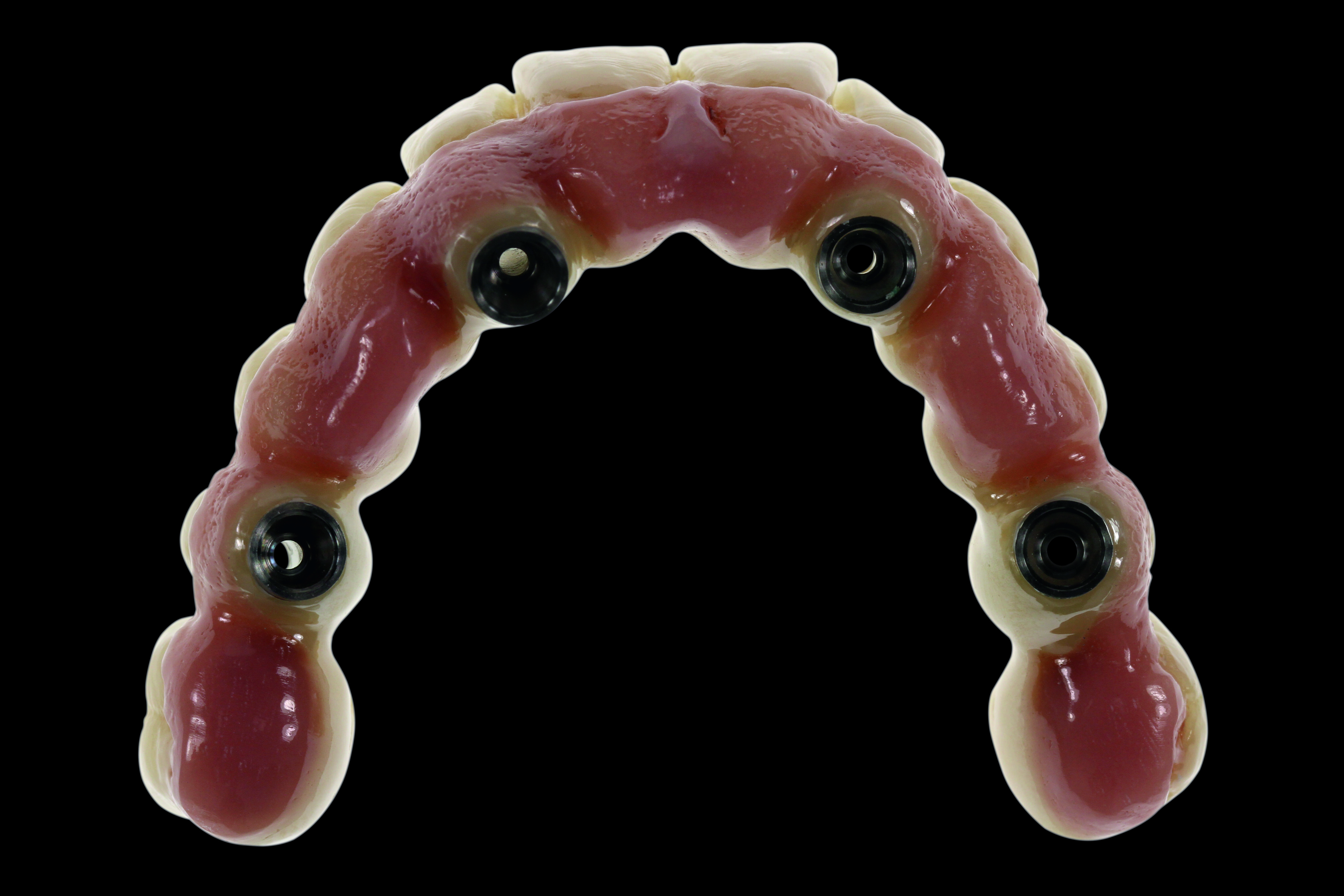 Ολοκληρωμένη άνω αποκατάσταση All-on-4 σε κεραμική ζιρκονία.